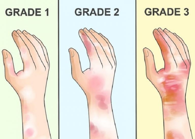 What are the hazards of HF and other glassattacking reagents? Microlit